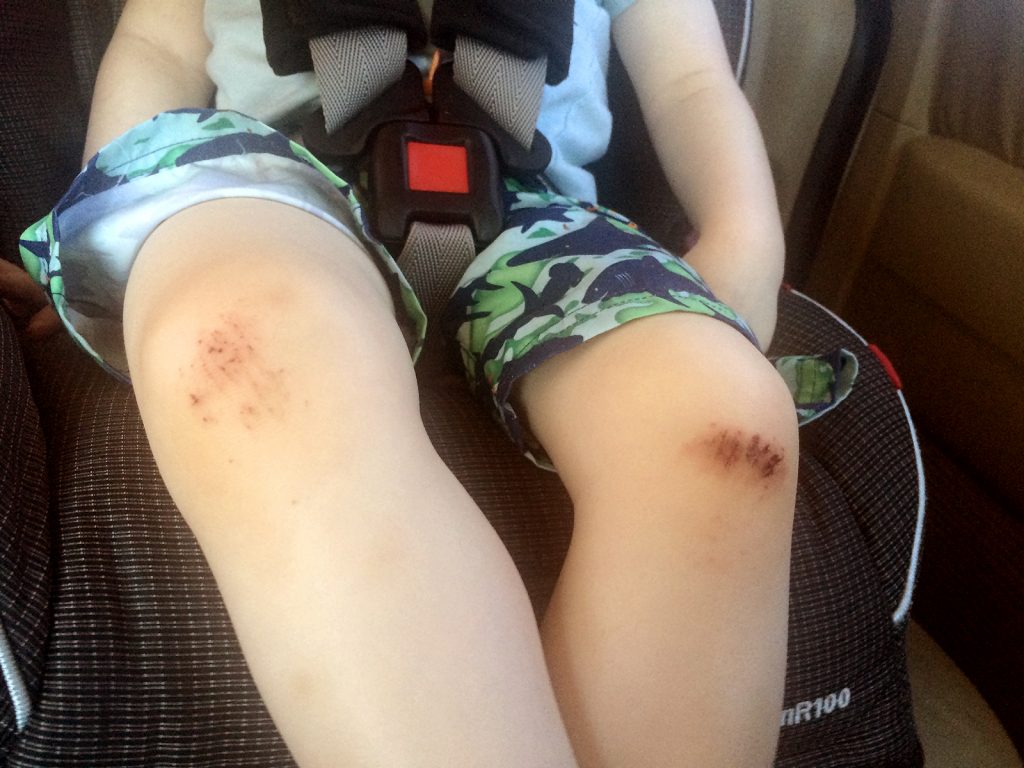 Fitz 2 years April 2016 knees bloodied _4838